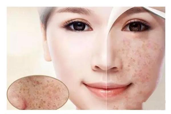 蘆薈膠祛斑的正確用法(用蘆薈膠正確祛除斑點)?